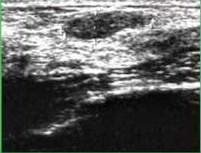 Ultrazvucni snimak fibroadenoma dojke