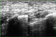 Ultrazvucni snimak izrazene displazije dojke pracene adenozom