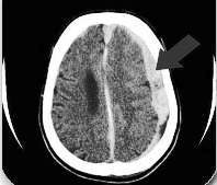 CT snimak mozga